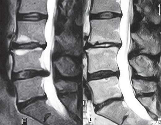 МРТ позвоночника после УБР