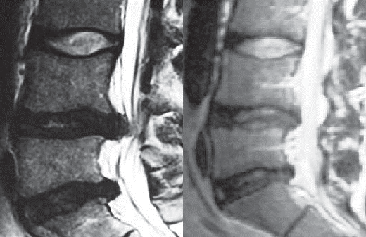 МРТ поясничного отдела позвоночника до и после УБР